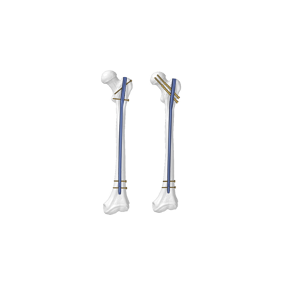 Expert Femoral& Reconstruction nail